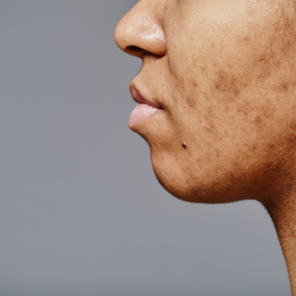 Helps reduce acne and pigmentation