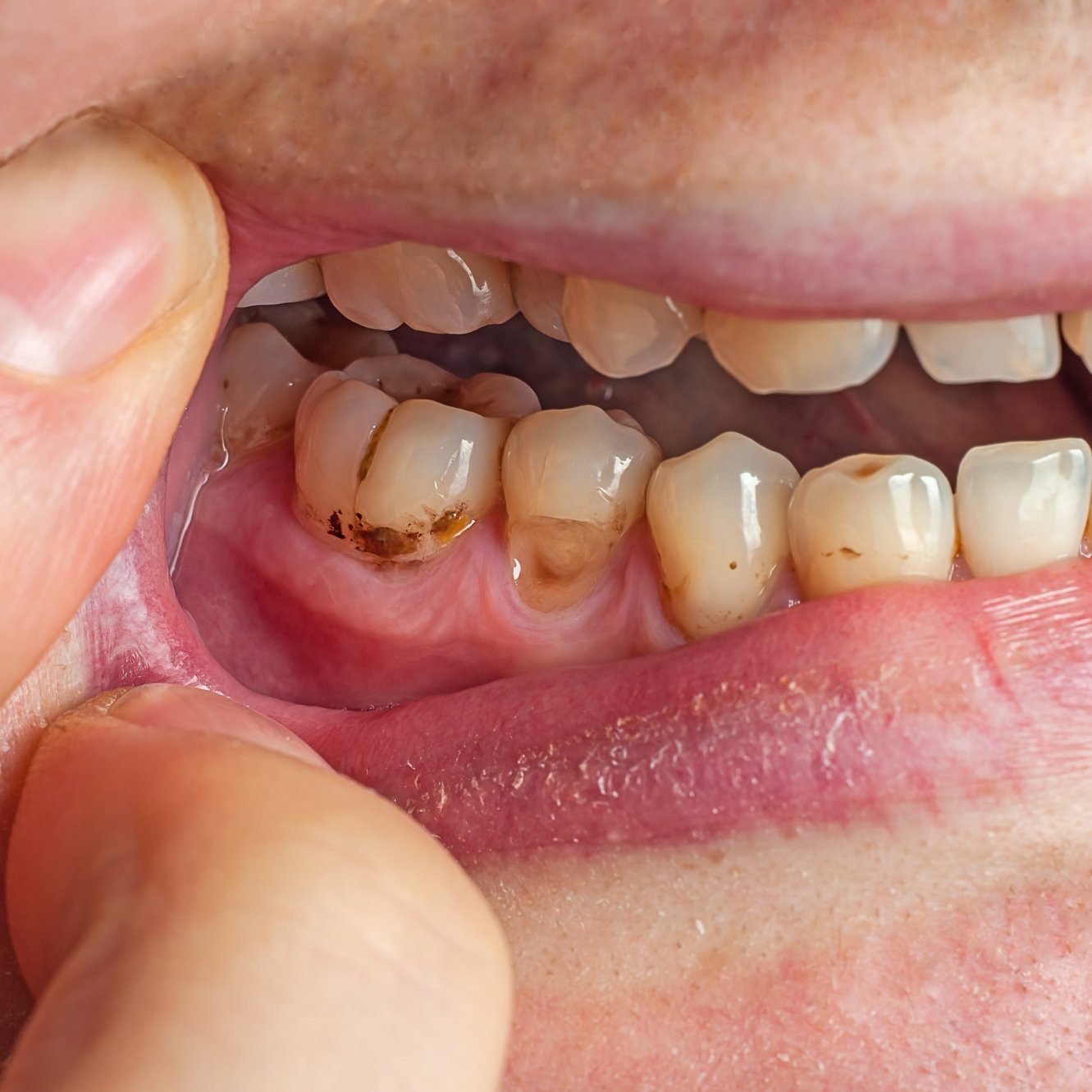 Strengthens Teeth & Gums